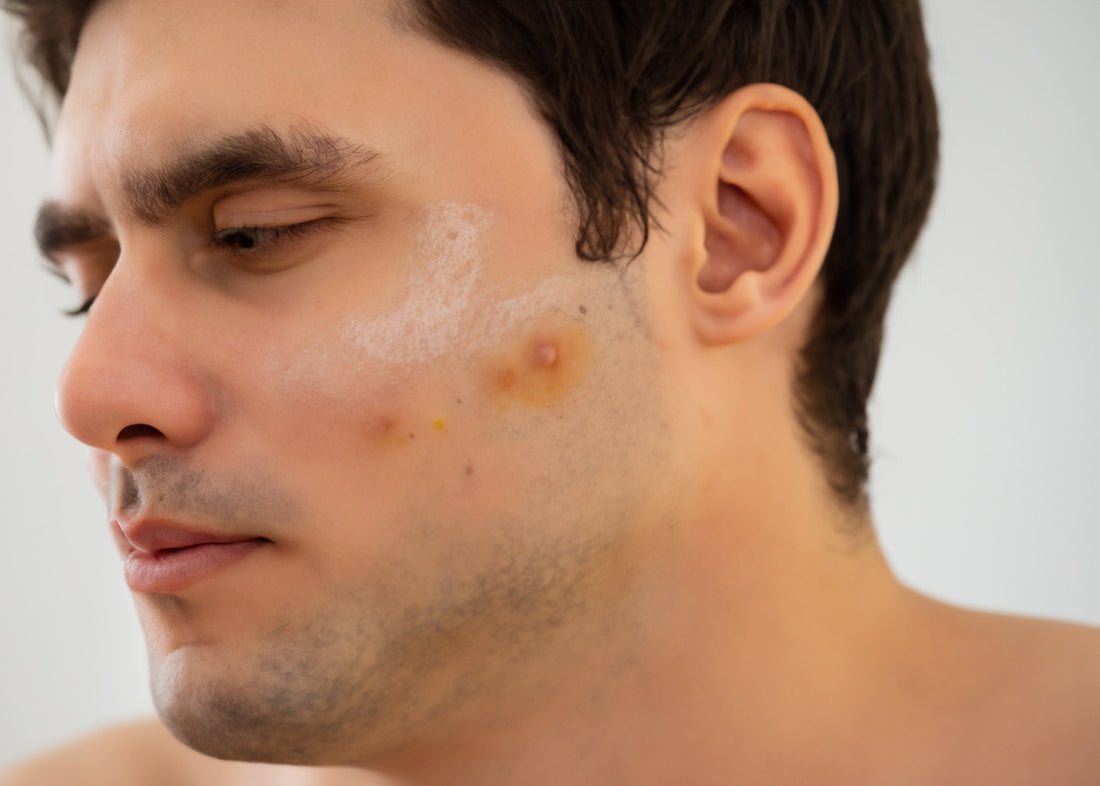 Nabhi Veda Acne & Scar Navel Oil: Say Goodbye to Acne and Scarred Skin